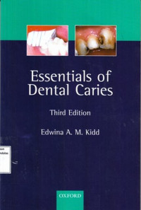 Essentials Of Dental Caries : The Disease And Its Management