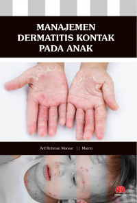 Manajemen Dermatitis Kontak Pada Anak