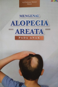 Mengenal Alopecia Areta pada Anak