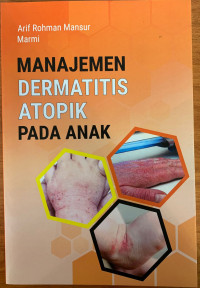 Manajemen Dermatitis Atopik Pada Anak